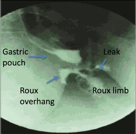 stomach leak symptoms|Anastomotic Leak After Gastric Bypass Surgery